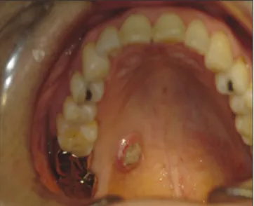Fig. 3. Excised mass of tumor and underlying bone.  Fig. 4. Intraoral view of postoperation state.