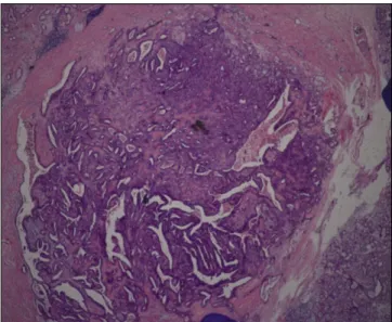 Fig. 5. Ten months after surgery: operation site is unremarkable. Fig. 6. Histological overview.(H&amp;E staining, original magnifi- magnifi-cation 4×10)