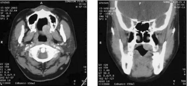 Fig. 2. CT findings of CEOT with the clear border without bone destruction.(CT: computed tomography, CEOT: calcifying epithelial odontogenic tumor)