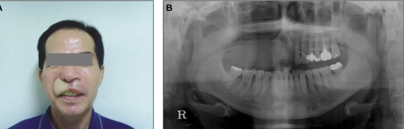 Fig. 11. Postoperative 1 month clinical and panoramic view showing well reconstructed soft tissue defect and partial maxillectomy site on right maxilla area