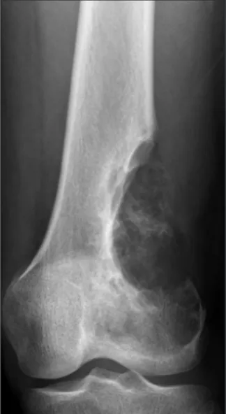 Figure 3. Plain radiograph of a 20-year-old man showing predominantly  lytic lesion in the distal femur
