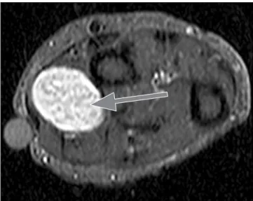 Figure  3.  Fascicular  sign.  Multiple  ring-like  structures  are  seen  throughout the lesion (arrow).