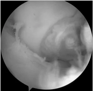 Figure 2. The mass was visible at the anterolateral area of the PCL by  arthroscope.