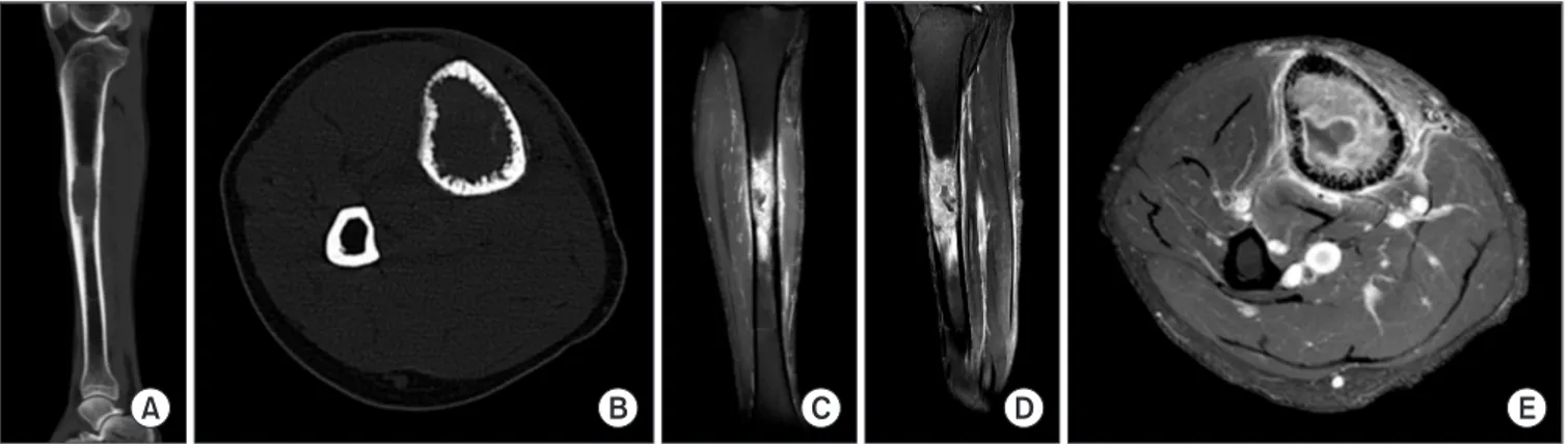 Figure 2. (A, B) CT showed an intramedullary lesion with permeative endosteal bone destruction