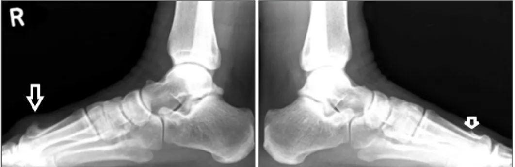 Figure 1. Arrow at plain radiograph shows  a bony mass in the both 1 st  metatarsal 