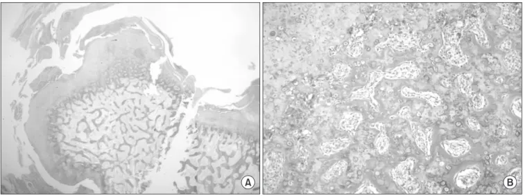 Figure 4. The specimen was examined histologically, the lesion is composed of a cartilaginous cap, calcified cartilage matrix, cancellous bone, spindle  cell that compose fibrous tissue