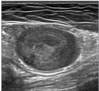 Figure 1. The ultrasonographic finding shows well defined heterogenous  echogenic mass.