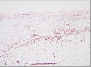 Fig. 6. The  mass  is  composed  of  mature  fat  cells  having only  a  slight  variation  in  cellular  size  and  shape.(H&amp;E staining, original magnification ×200)
