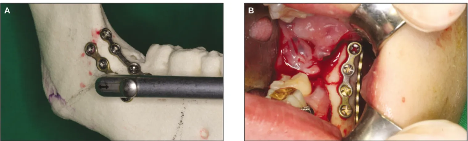 Fig. 1. Internal fixation on mandibular angle was performed using contra-angle drill laterally.
