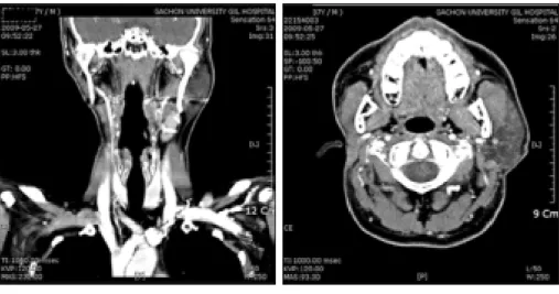 Fig. 6. No  definite  evidence  of  local recurrence  and  significant  lymph  node in bilateral neck (post op 36 months)