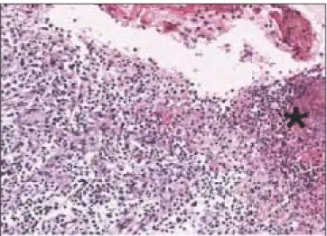Fig. 9. Cavity  epithelium  (The  time  of  marsupialization, H&amp;E, ×100).