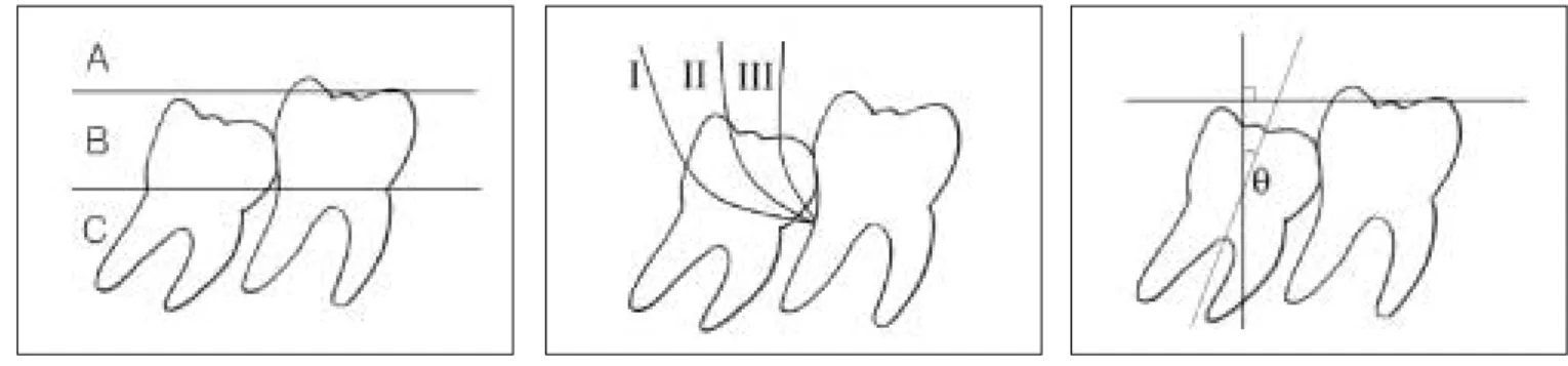 Fig. 2. Schematic drawing of the relation to  the  anterior  border  of  mandibular ramus.
