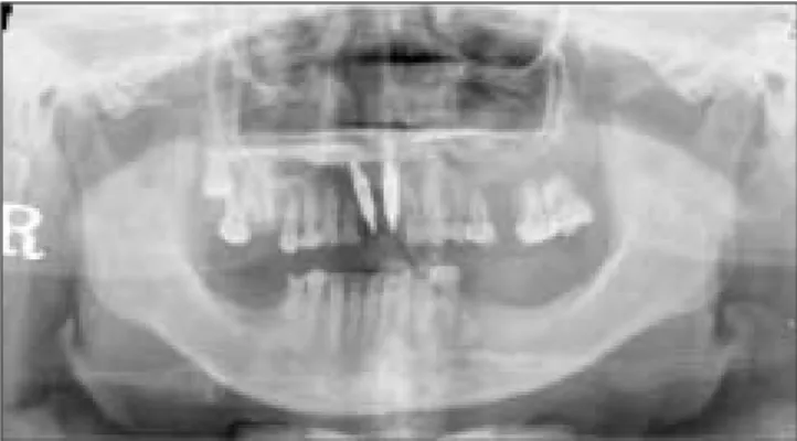Fig. 3. Bleeding view of on #38 tooth extraction wound.