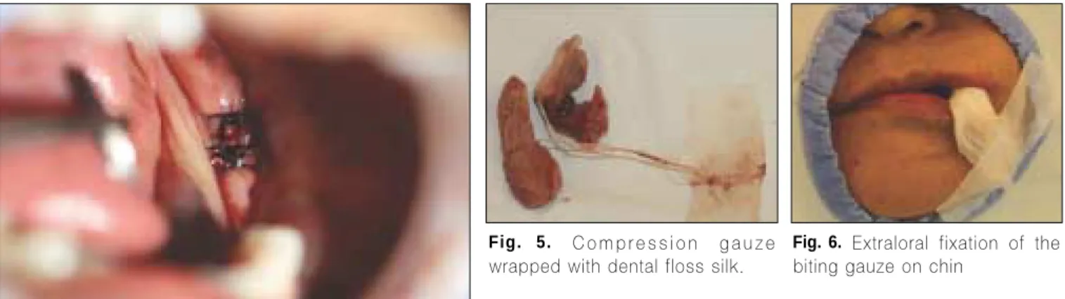 Fig. 5. Compression  gauze wrapped with dental floss silk.