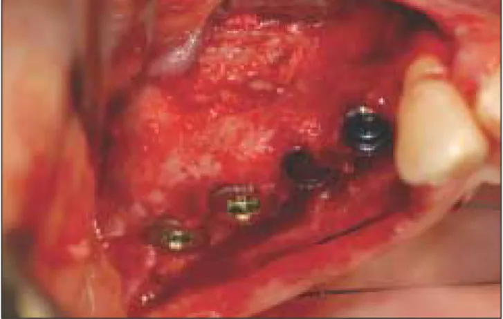 Fig. 2. Sinus lifting and implantation.