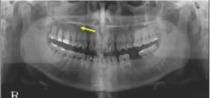 Fig. 1. Pre-operation panoramic view : radiolucent lesion on Rt. posterior maxilla with irregular margin.