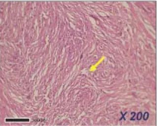 Fig. 5. Photomicrograph showing diffuse staining with smooth-muscle specific actin (Original magnification
