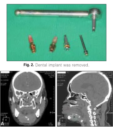 Fig. 3. Clinical view of lingual cortex perforation. 
