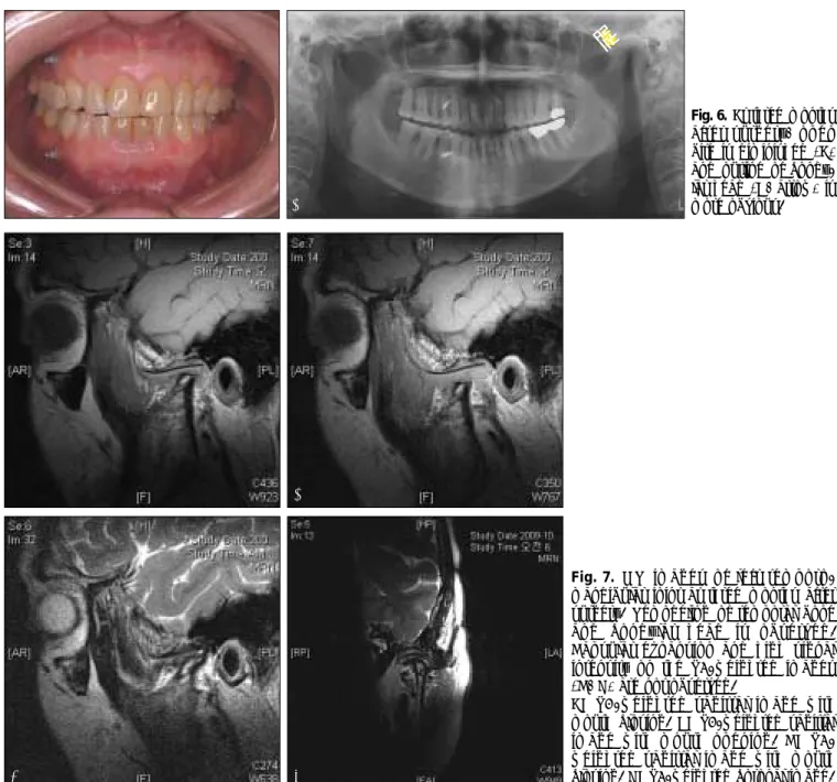Fig. 6. At three months after  surgery, open bite  is  diminished  (A) and  outline  of   condy-lar head (B, arrow) is more obvious.