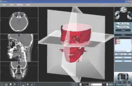 Fig. 3. Reference plane in 3D CT.