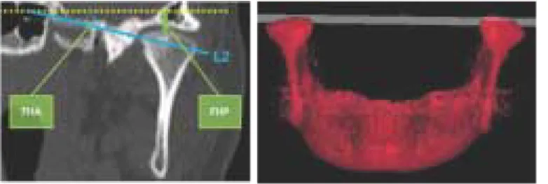 Fig. 5. In the frontal view, the slice that showed the greatest mediolateral dimension of the condylar head was selected.