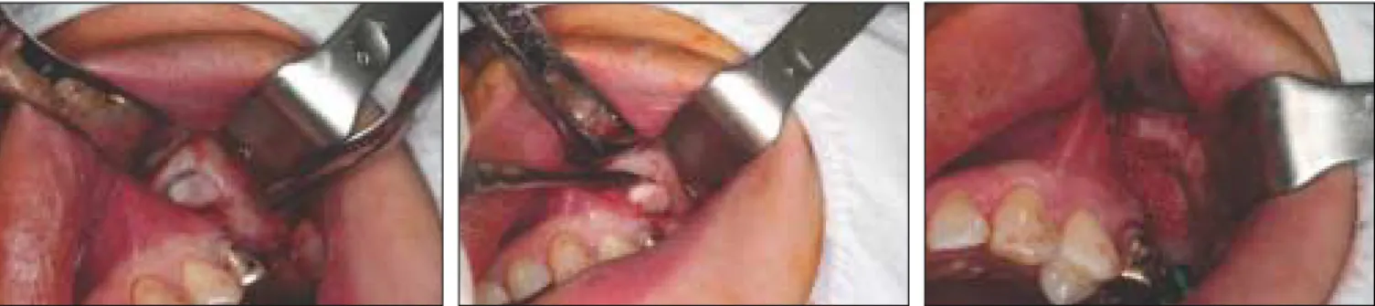 Fig. 2. Lateral  bone  segment  was  easily outfractured  to  secure  the  operation field  for  elevation  of  the  Schneiderian membrane