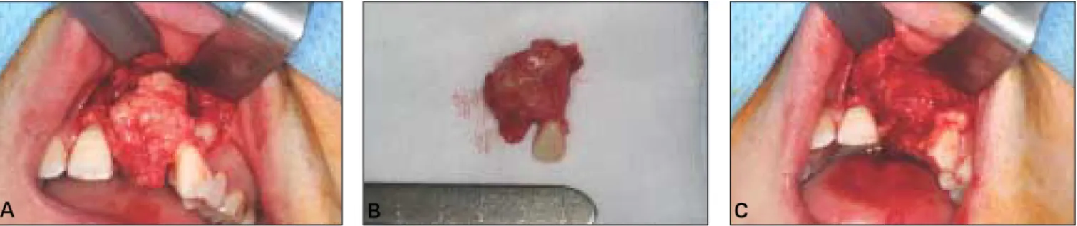 Fig. 3. Coronal &amp; axial CT scan showing cortical bone thin- thin-ning &amp; resorption
