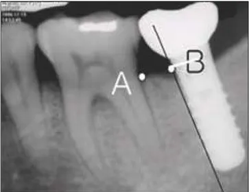 Fig. 3. Radiographic  mesurement  of  the  cantilever  distance between most distal alveolar crest of the last molar (A) and the  parallel  line  to  long  axis  of  mesial  surface  of  implant fixture (B)