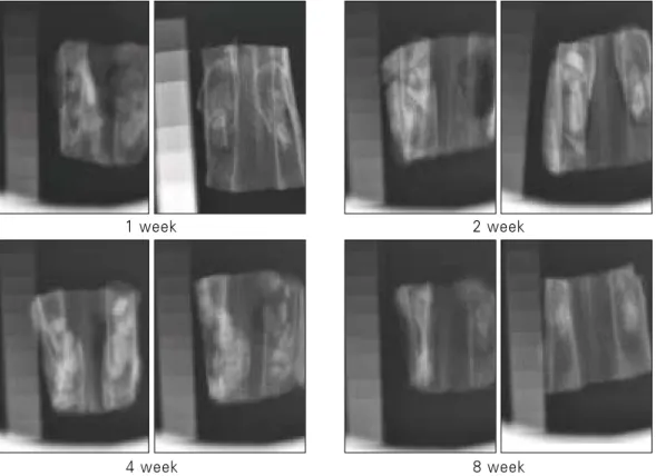Table 1. Change  of  mean  bone  density  by  radiographic finding.