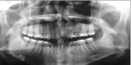 Fig. 1. Preoperative  panoramic  radiograph.  There  is  no  evidence  of  synovial  chon- chon-dromatosis.