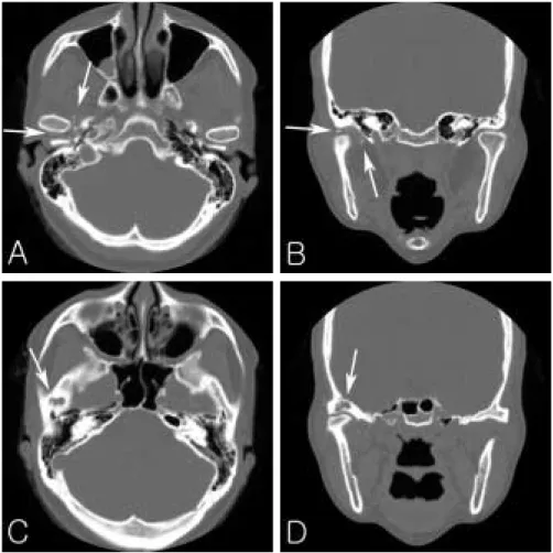 Fig. 3. Preoperative CT. CT show multiple calcified bodies in right TMJ space(A and B), and osteolytic lesion of temporal bone(C and D).