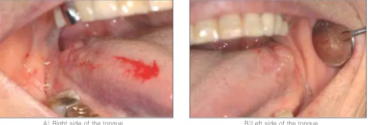 Fig. 1. Lateral surface of the tongue showed bilateral swelling with slightly redness &amp; seemed to adhere with adjacent tissues.