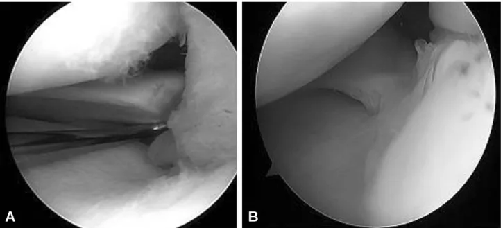 Fig. 1. We found meniscal root fibrotic healing at 2 nd arthroscopic finding. (A) pre-operative arthroscopic finding