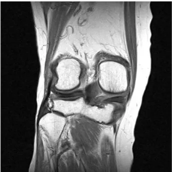 Fig. 4. We calculated that meniscal extrusion size was decresed. (A) Pre-operative MRI coronal image, extrusion is 4.2 mm (B) Post-