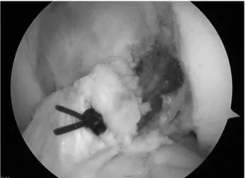 Fig. 4. A long tibial remnant tissue was sutured with absorbable