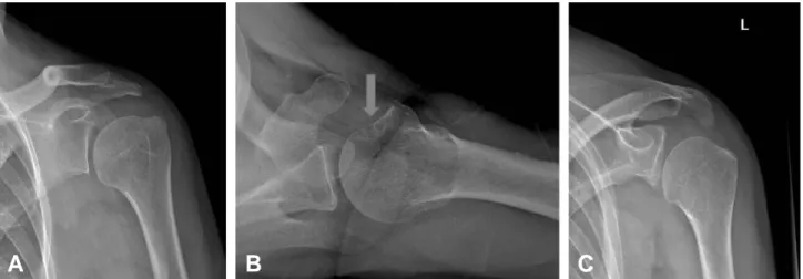 Fig. 1. A true AP radiograph of left shoulder shows widening of the acromiohumeral interval