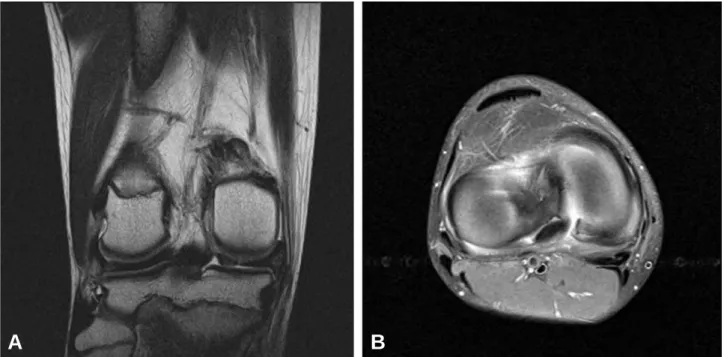 Fig. 1. Root tear of posterior horn of medial meniscus of right knee was seen on T2-coronal and axial MRI image.