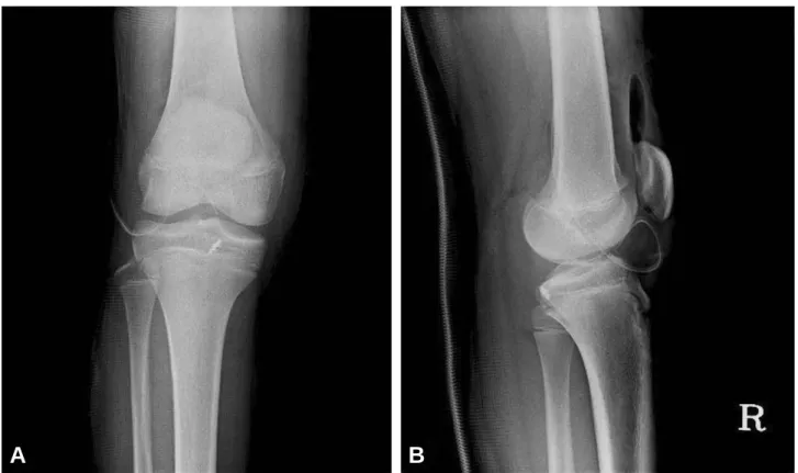 Fig. 3. Simple radiograph shows the suture anchor don’t interfere with the epiphyseal plate