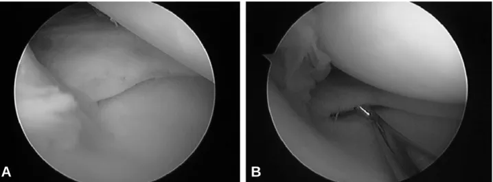 Fig. 5. 2nd look arthroscopic photograph shows complete healed (A) and well maintained tension (B) of root tear site of the medial meniscus through anterolateral portal of right knee.