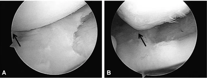 Fig. 2. Same patient. Arthroscopic finding using the anteromedial portal in knee flexion (A) and extension position