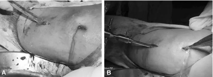 Fig. 2. Intraoperative photographs show irrigation and drainage of pus using 4.0 mm endoscope and curret inserted through two mini-