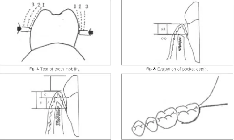 Fig. 3. Evaluation of gingival margin level. Fig. 4. Flap design.