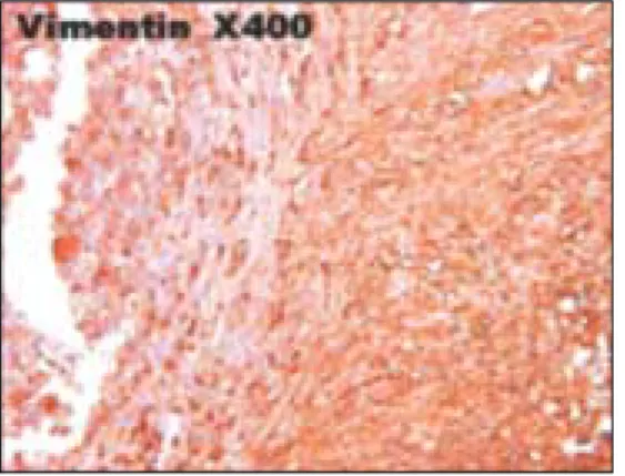 Fig. 7. Immunohistochemical  Staining  For  Vimentin  Of Control  Group  (×400):  Little  of  proliferation,  migration  &amp;