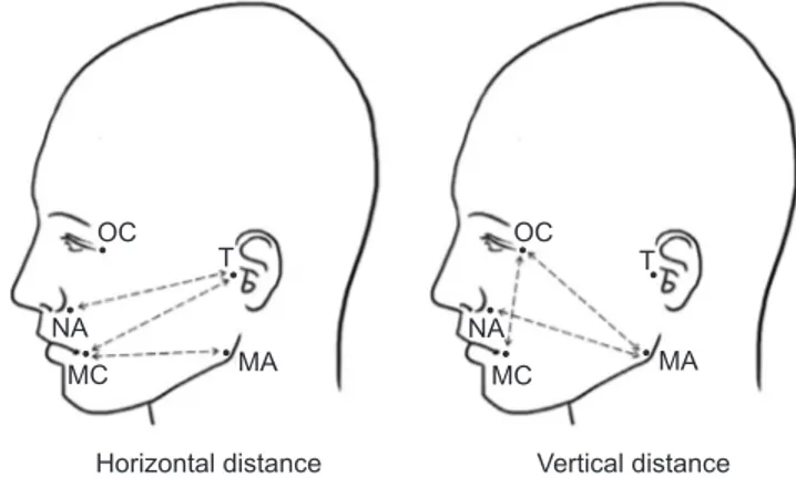 Fig. 1. Measurement points: tragus (T), mouth corner (MC), nasal 