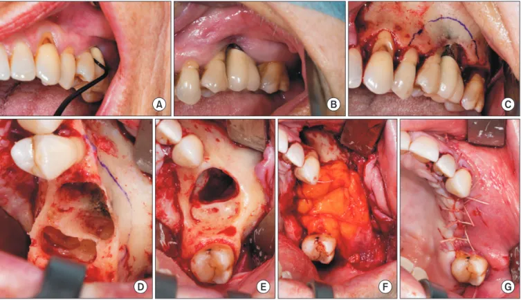 Fig. 1. A 64-year-old female patient; underlying disease: osseous metastasized breast carcinoma; antiresorptive therapy: zoledronate  4 mg every 4 weeks intravenously over 4 years; presentation with unspecific symptoms of the upper jaw (recurrent pain and 