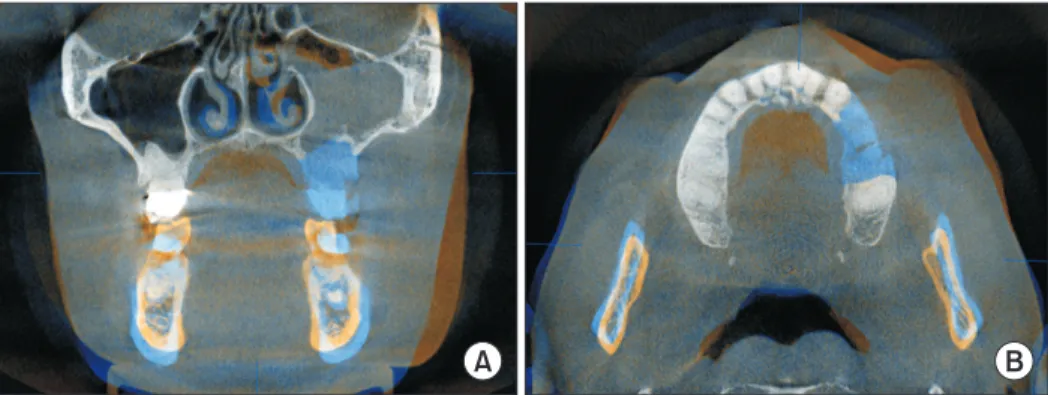 Fig. 2. Fused preoperative (blue) and postoperative (orange) cone-beam computed tomography scans in coronal (A) and axial (B) views:  the resection defect in the upper jaw on the left side is highlighted in blue