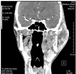 Fig. 7. The right condyle was fixed openly, and the left condyle 