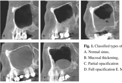 Fig. 1. Classified types of sinus abnormalities in the cone beam CT A. Normal sinus,