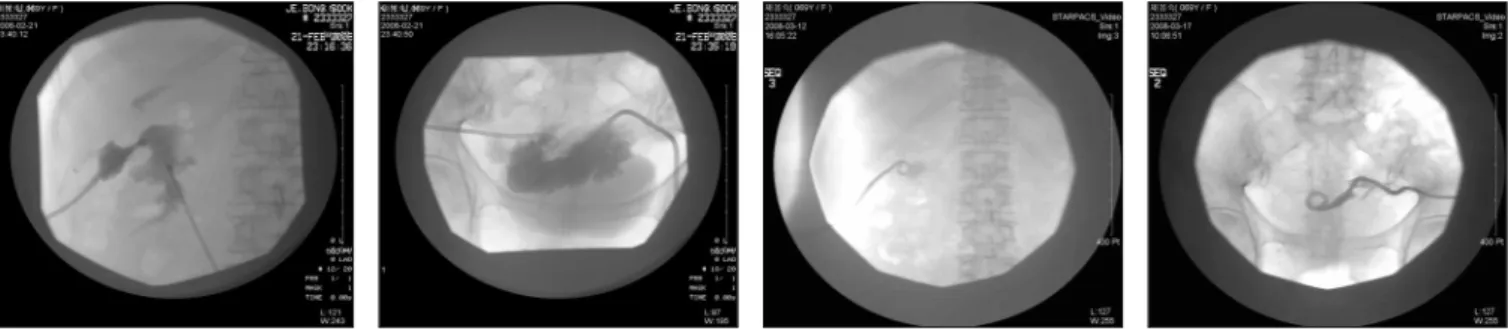 Fig 3-2. USG with fluoroscopy shows pus collection and PCD insertion on lower abdominal area