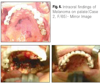 Fig. 7. Intraoperative findings-removal of the lesion (Left)